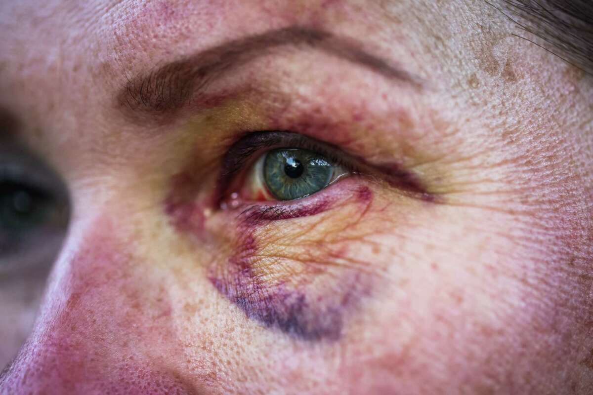 2023年2月15日，周三，加利福尼亚州旧金山，一名女子(不愿透露姓名)的眼睛受伤，周日，她和丈夫一起在第18街和多洛雷斯街被两名骑着摩托车的女子野蛮袭击。