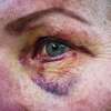 2023年2月15日，周三，加利福尼亚州旧金山，一名女子(不愿透露姓名)的眼睛受伤，周日，她和丈夫一起在第18街和多洛雷斯街被两名骑着摩托车的女子野蛮袭击。