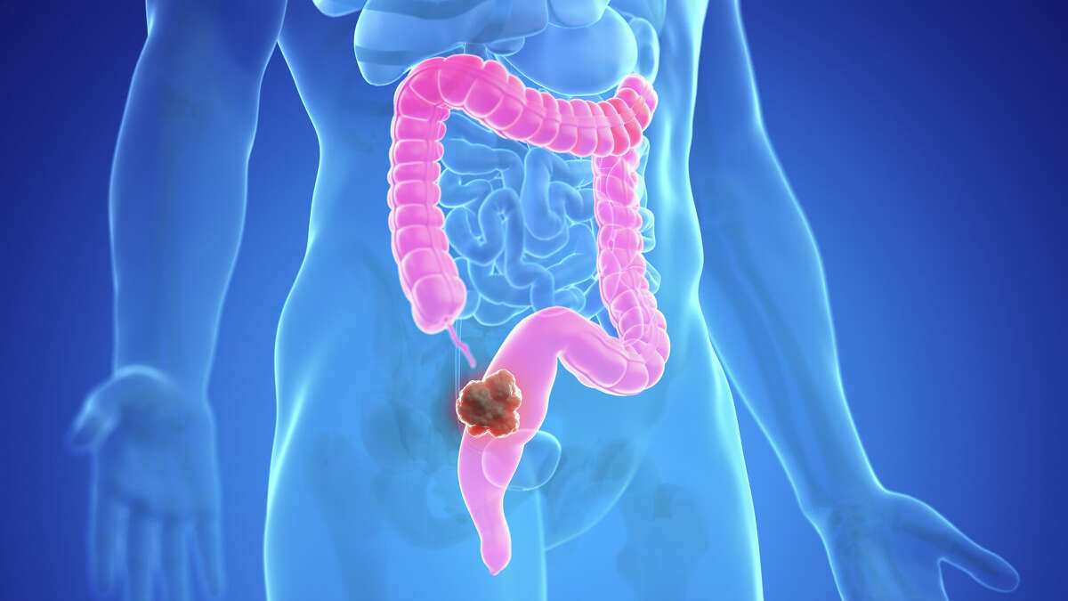 This photo illustration depicts colon cancer, which is the second most deadly cancer in the United States after lung cancer.   
