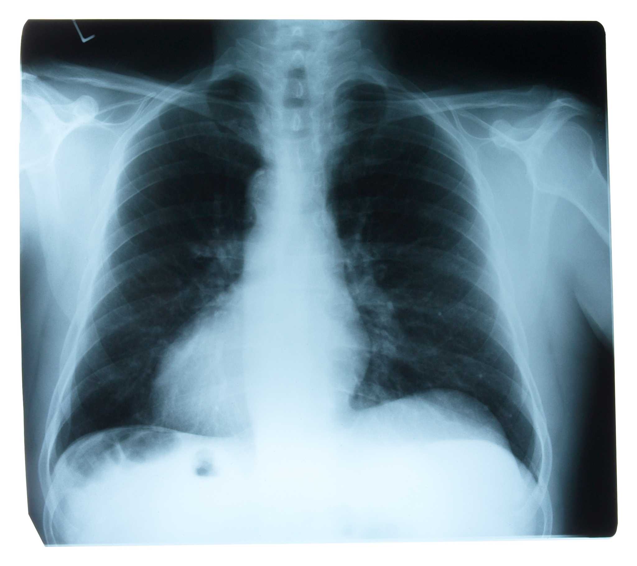 what-is-the-lung-capacity-for-a-woman