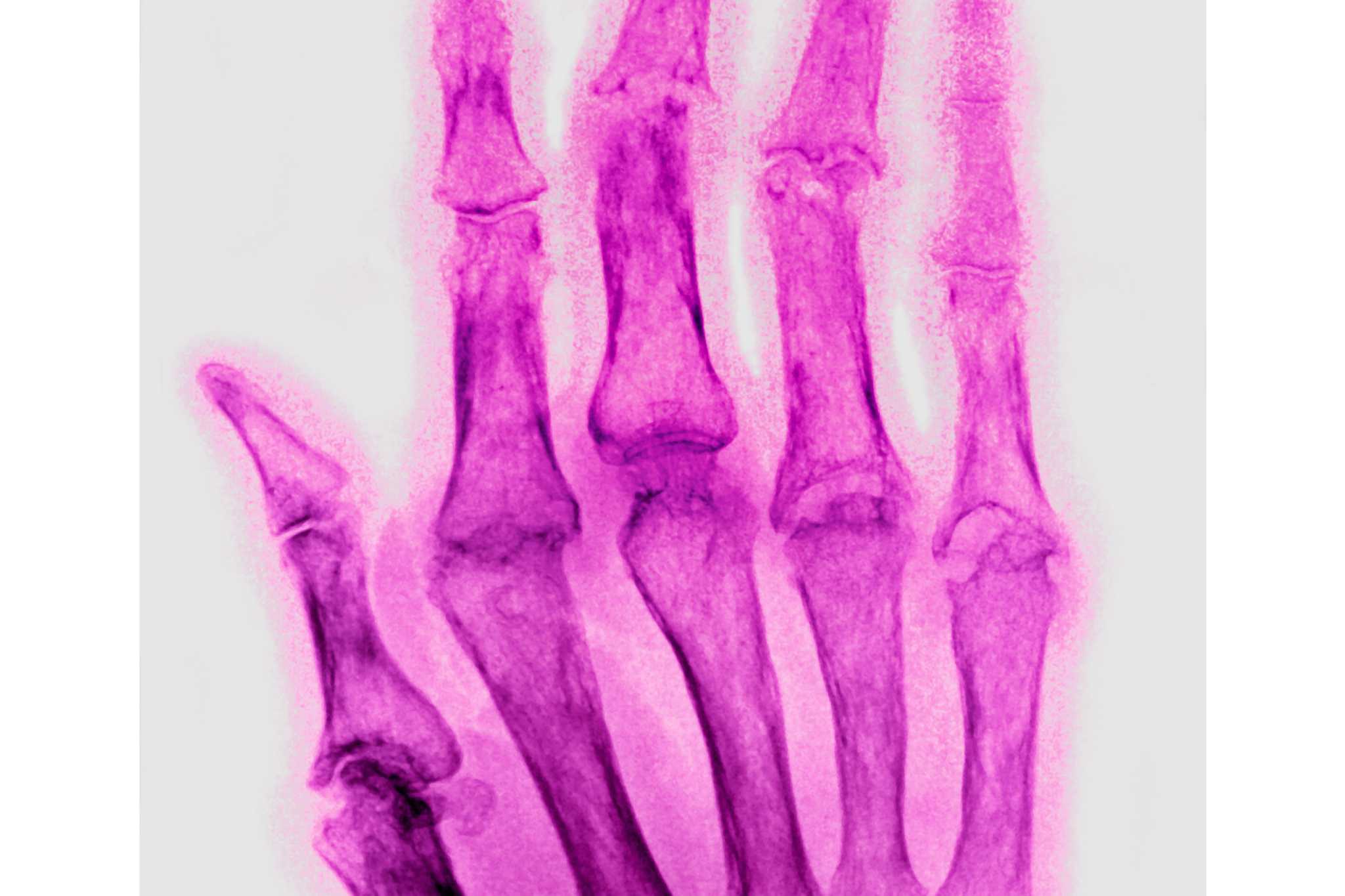 Why do more women get autoimmune diseases? Stanford study finds a clue
