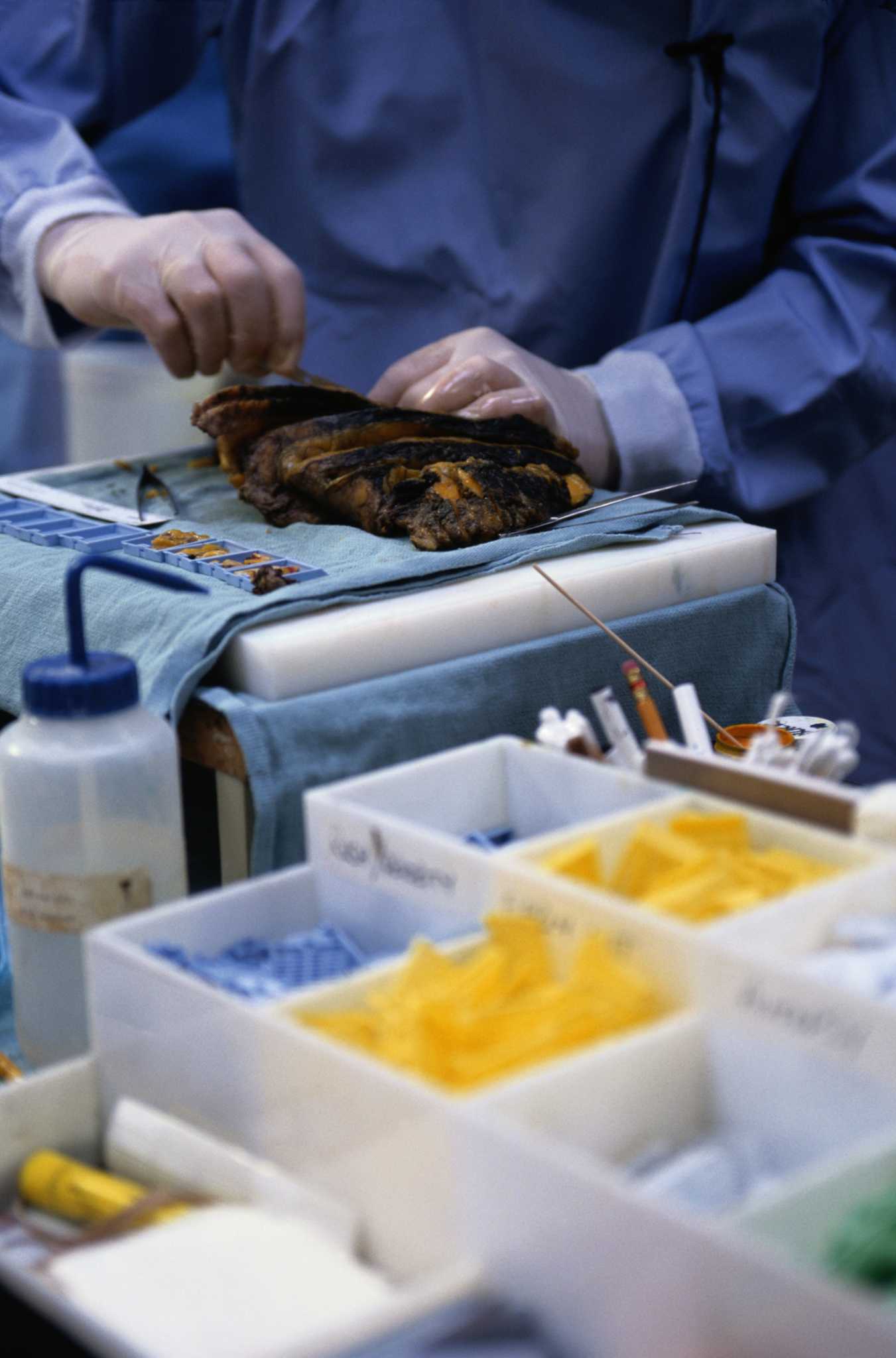 What Should I Major in to Be a Pathologist?