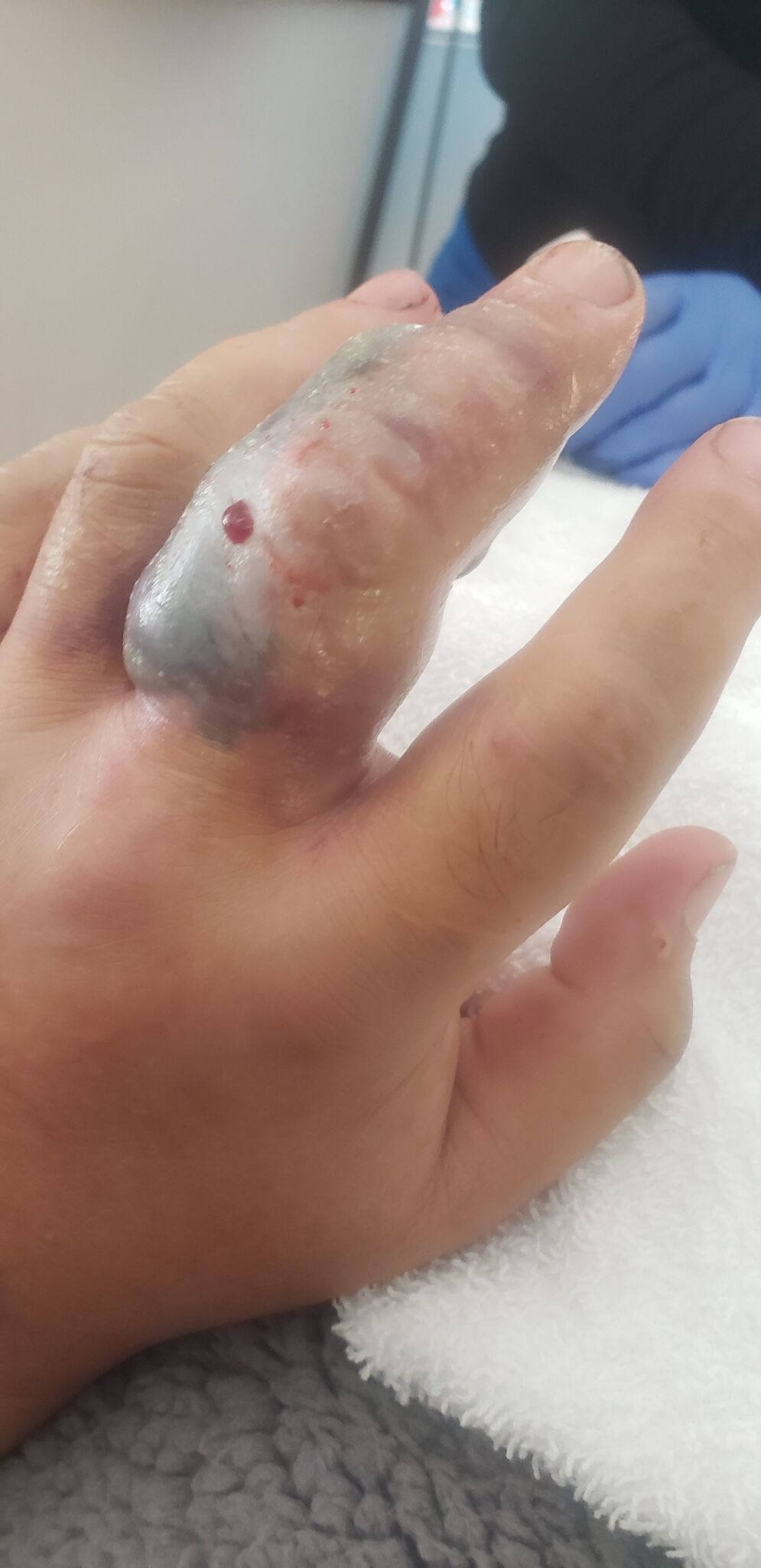 CT rattlesnake bite victim describes near-death experience