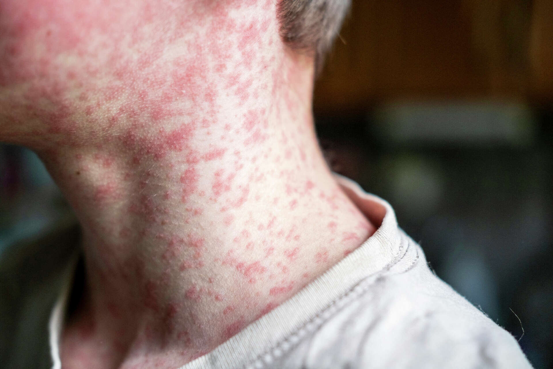 Measles outbreak in Texas called into question