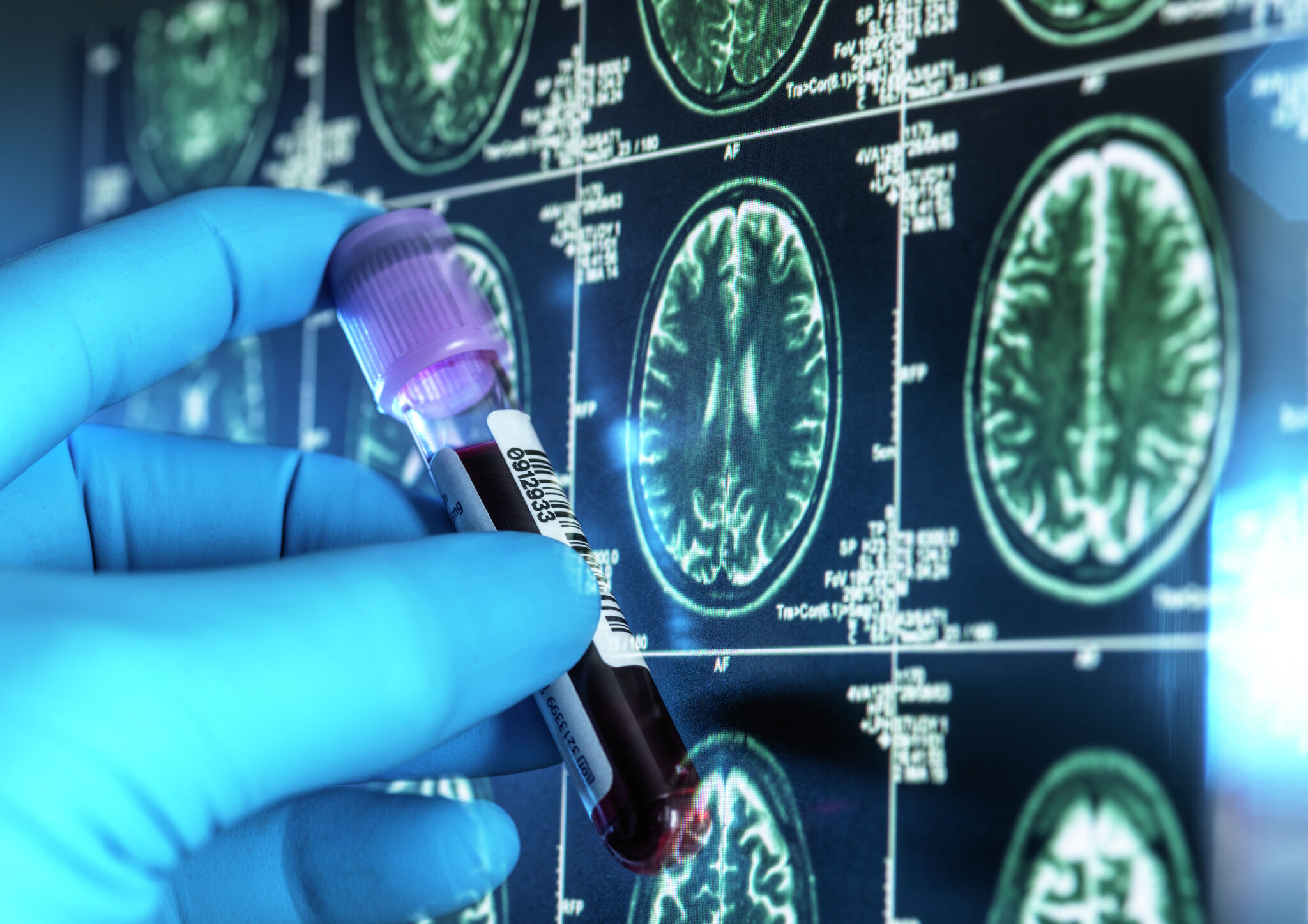 New Alzheimer’s blood tests make diagnosis easier — but they’re not right for everyone - San Francisco Chronicle