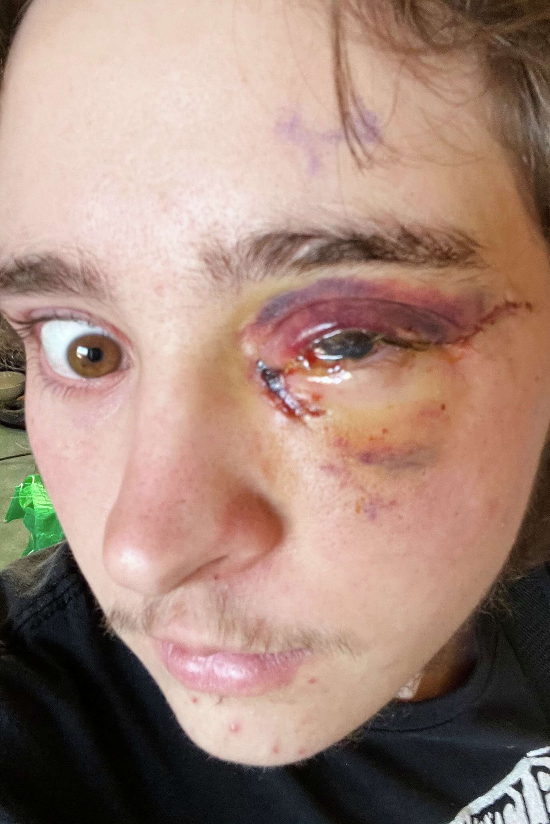 Demonstrator injured after federal agent fired projectile from close range during California protest