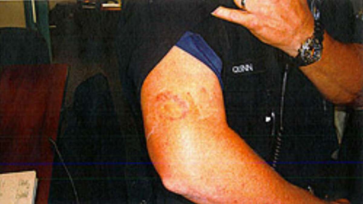 A picture of the alleged bite, from a court filing.