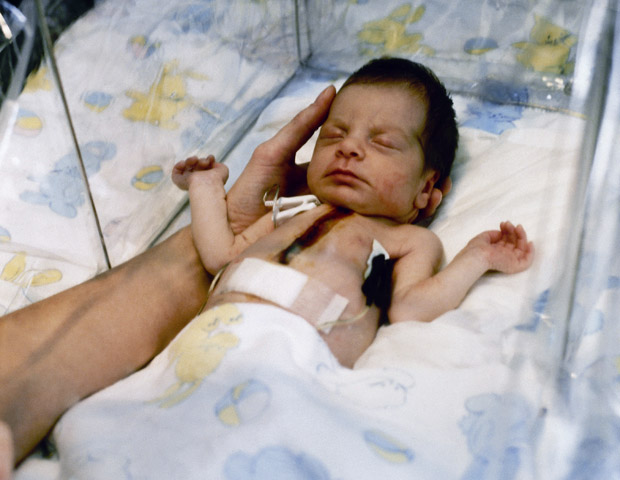 Today in photo history – 1984: Baby Fae first human to receive baboon heart
