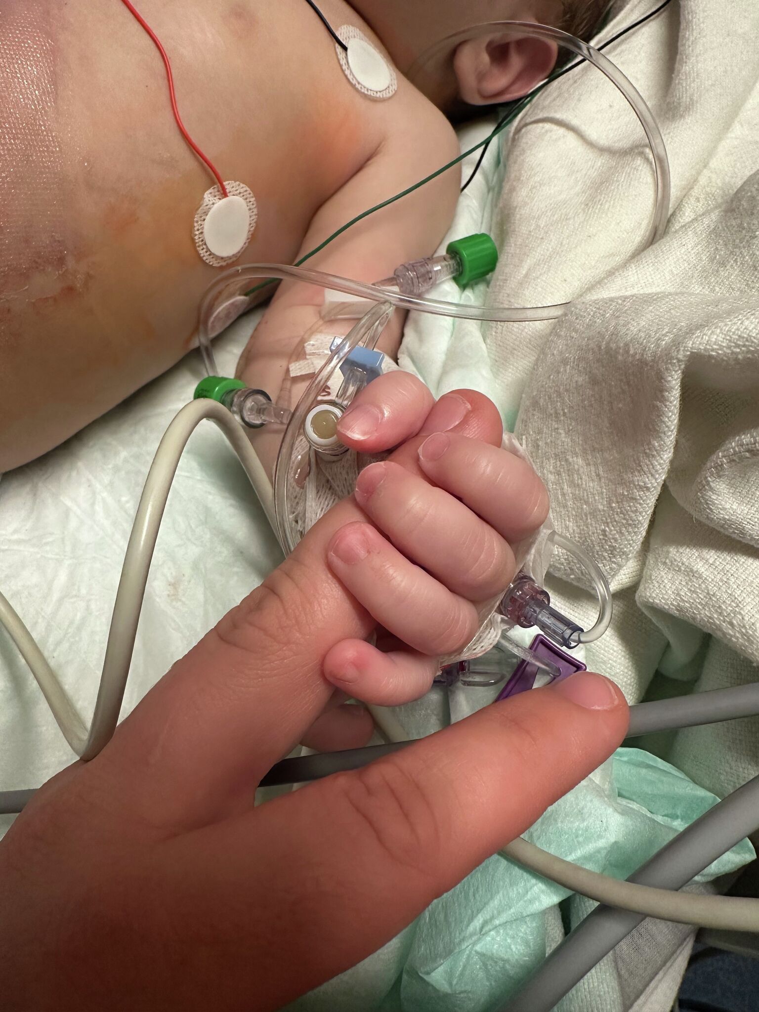 Lebertransplantation rettete Säugling in Nordtexas mit Gallengangsatresie