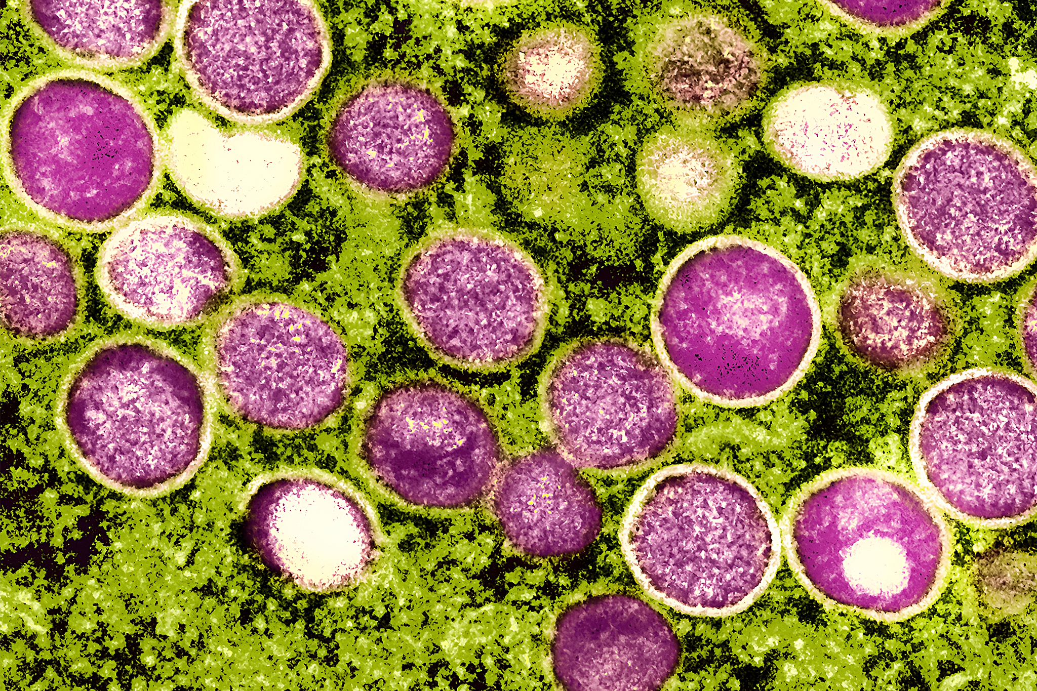 Calif. officials concerned as mpox cases rise