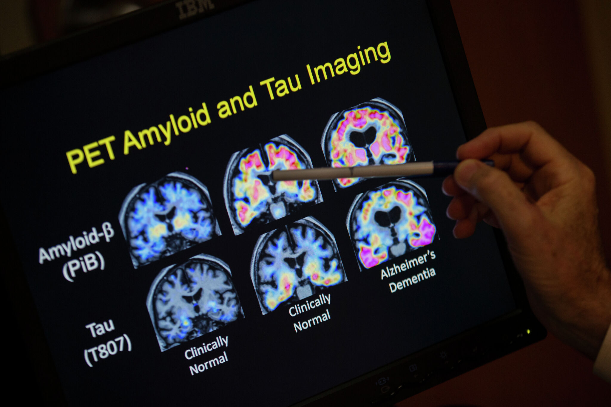 Photo: Jacksonville Journal-Courier 5 Biomarkers Close the Diagnostic Gap in Dementia