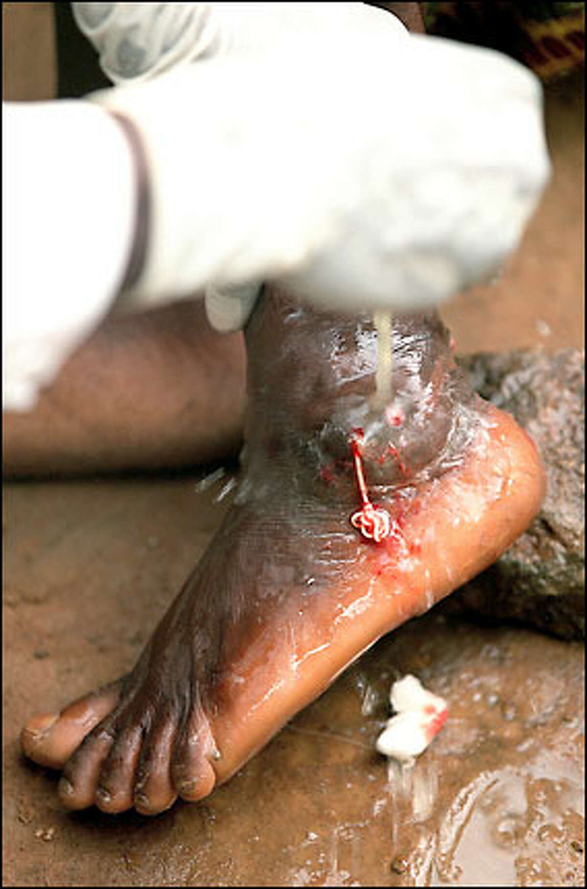 The guinea worm -- this one strangely knotted -- is coaxed from Malik's ankle during a procedure performed in public. Villagers often make a party out of the worm extractions to get people to attend and learn how to protect themselves.