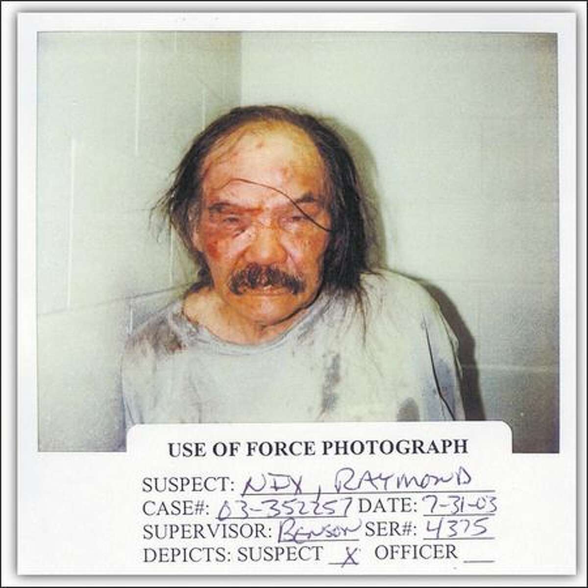 Raymond Nix was beaten so badly by police officers outside of a Denny Regrade bar that he nearly died four days later from a lacerated spleen. This photo was taken shortly after his July 31, 2003, arrest. (Photo provide by King County Prosecutor's Office)