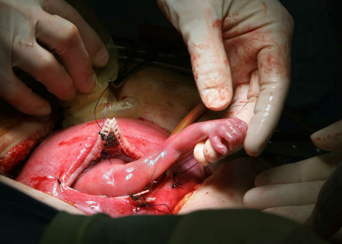 This photo from another operation illustrates how fetal surgery is done.