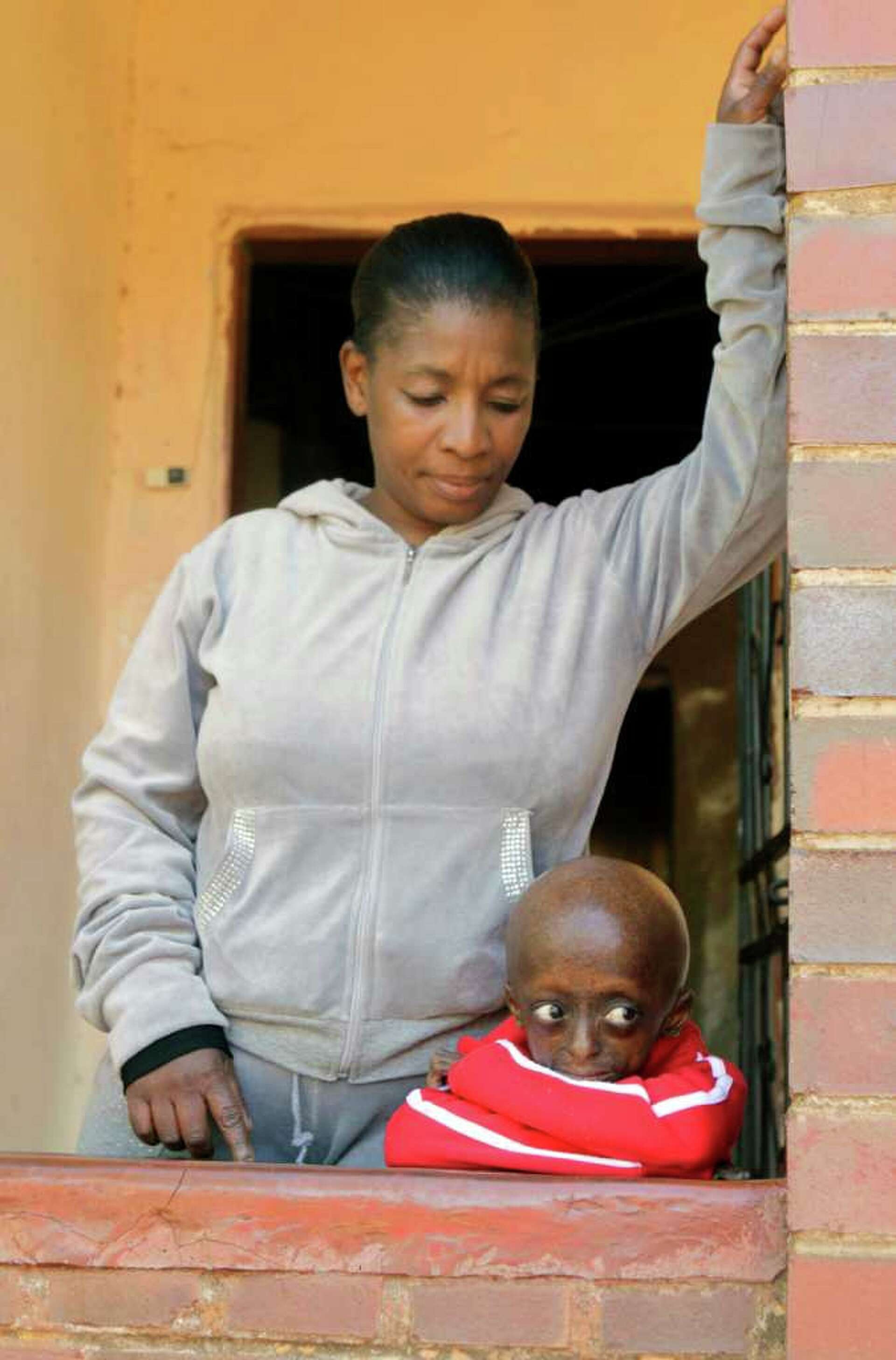 S. Africa has first black child with progeria