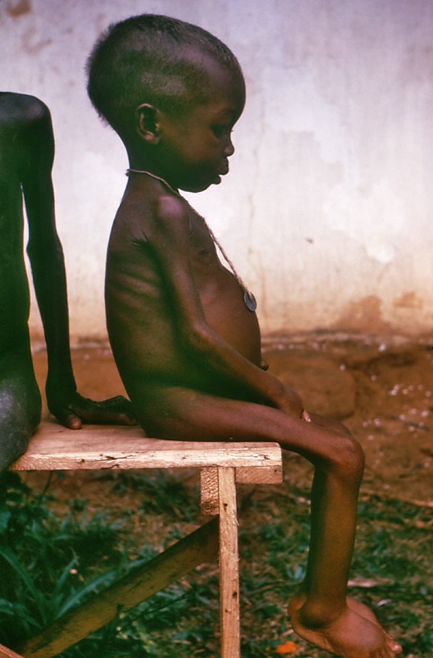 Kwashiorkor cited by Prime Healthcare in bills