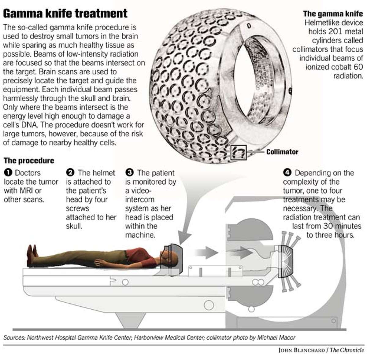 Gamma knife has great success against small brain tumors