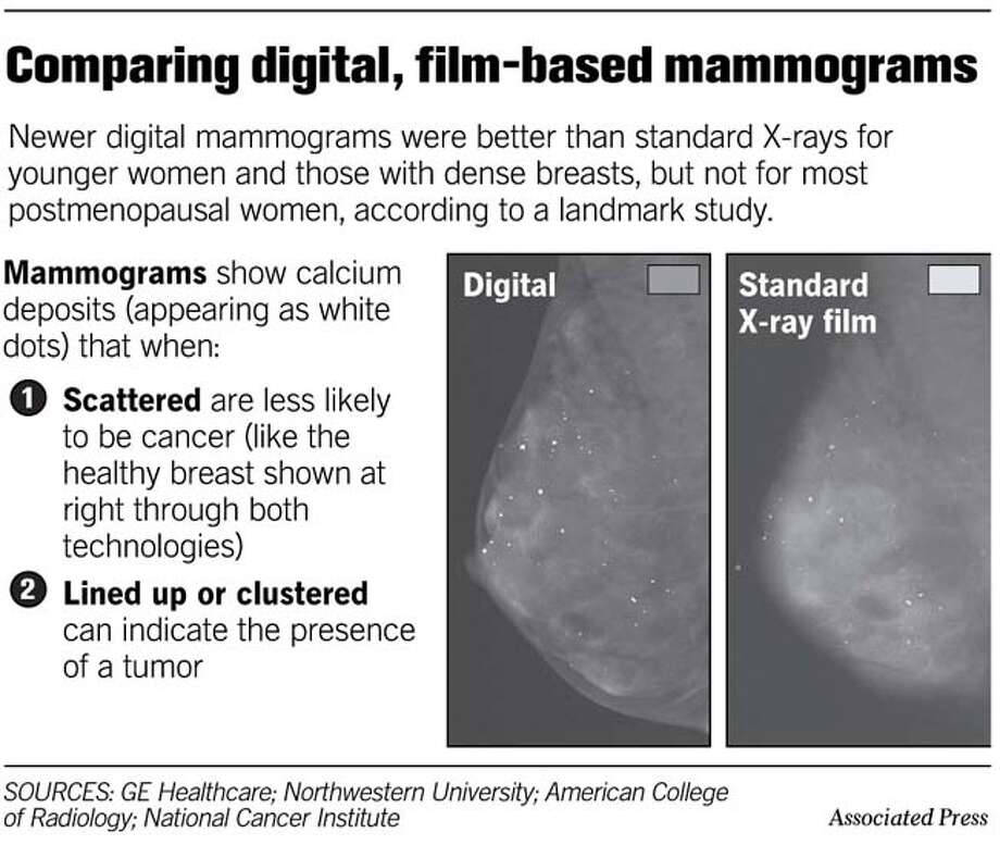 Digital Mammograms Found Better For Younger Women Sfgate
