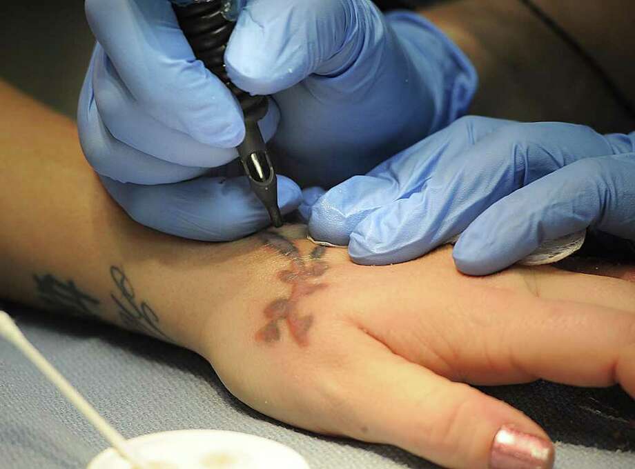saline tattoo removal at home