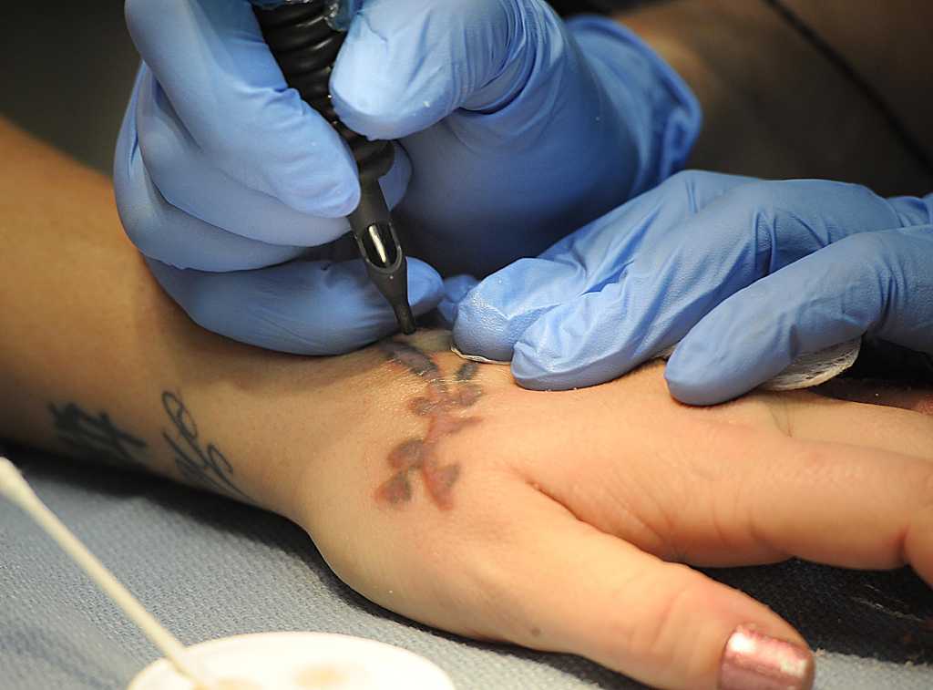The agony of tattoo removal - San Antonio Express-News