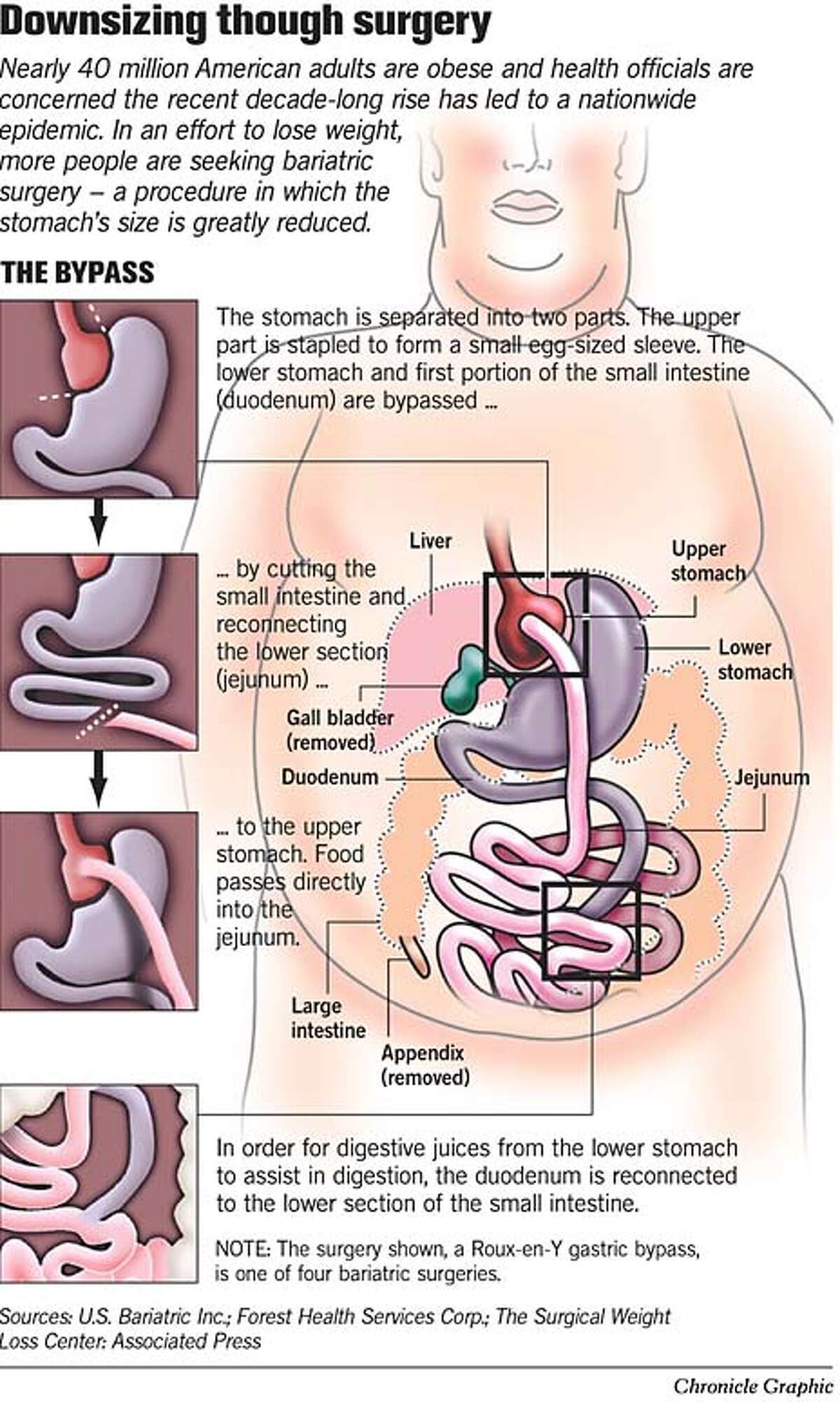 LAST THIN HOPE / A less invasive, controversial stomach reduction