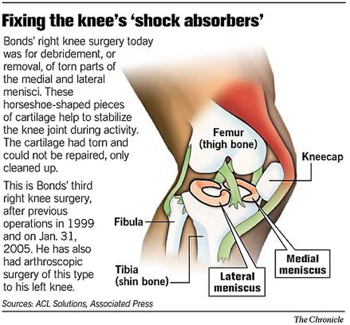 Bonds 'back at square 1' / Slugger has right knee scoped again, is
