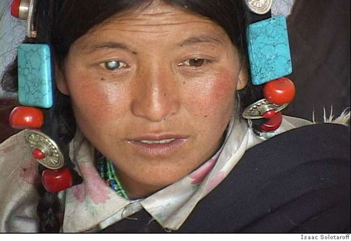 Nomad woman with cataract in her mid-20's (don't have record of her name) at a Tibet Vision Project eye camp in Sok Xian in September 2002 awaiting surgery. Photo by Isaac Solotaroff