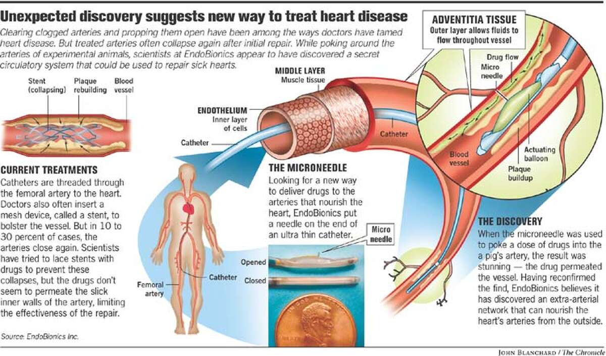 Unexpected Discovery Suggests New Way to Treat Heart Disease. Chronicle graphic by John Blanchard