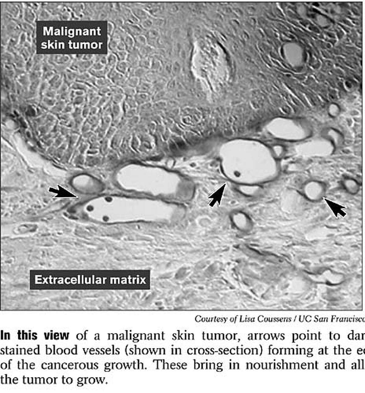 Malignant Skin Tumor. Photo courtesy of Lisa Coussens, UCSF