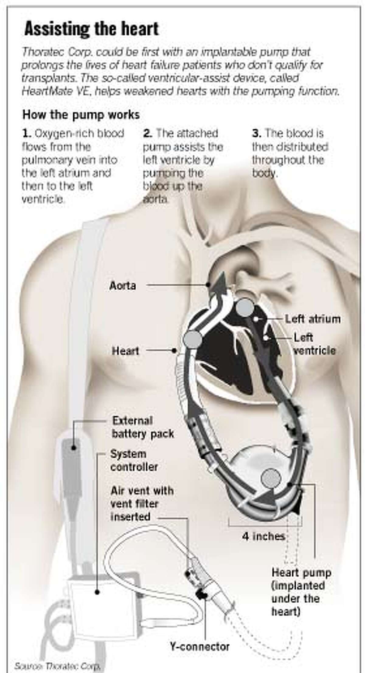 Heart Pump's Future In FDA's Hands / Device Offers Hope In Some Cases ...