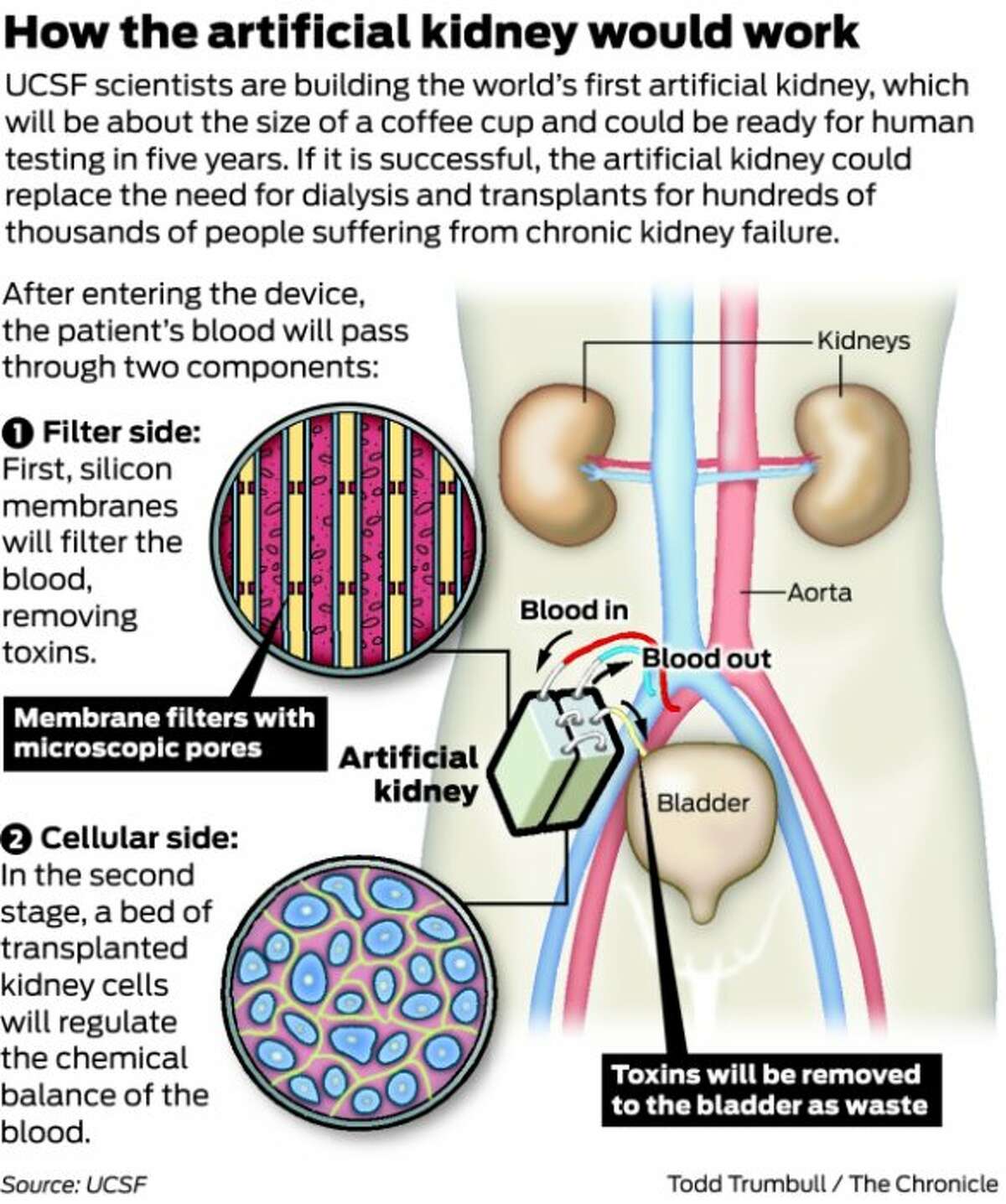 UCSF team working on artificial kidney