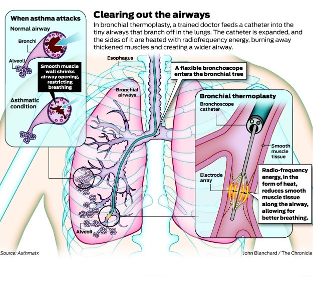 Bronchial thermoplasty can help chronic asthma