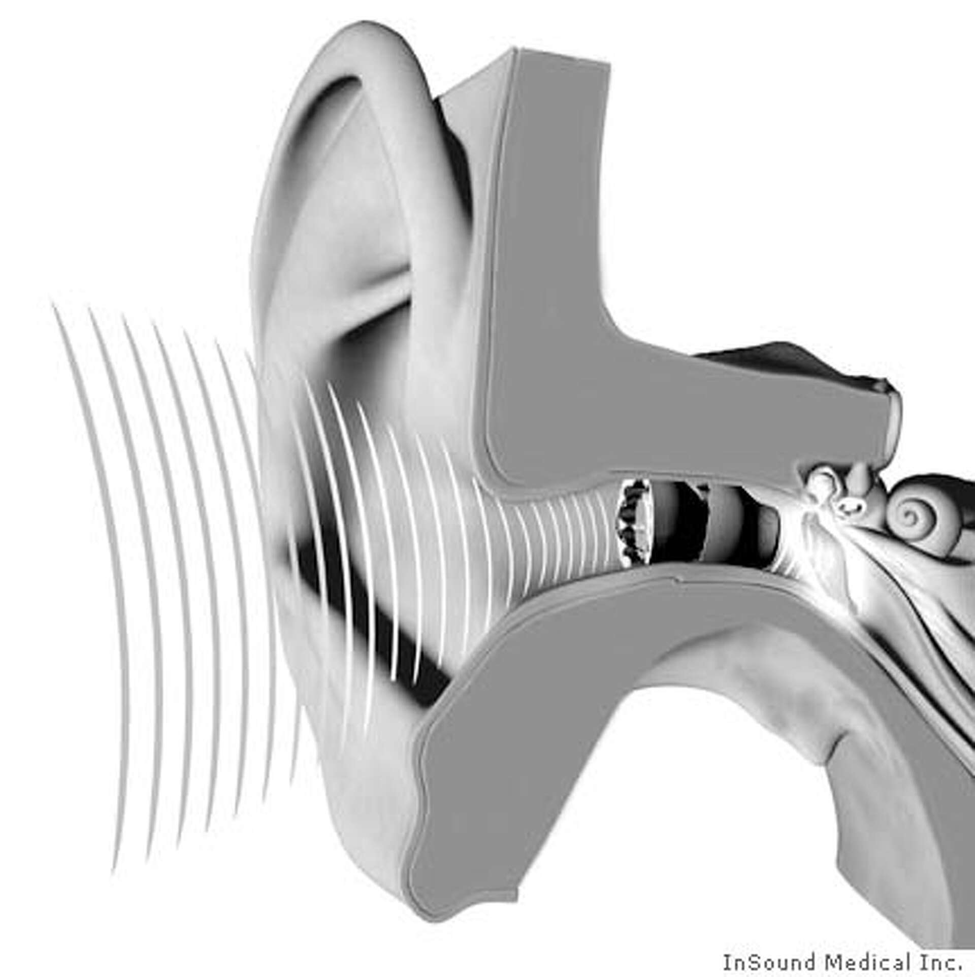 Ear Insilating InSound's new hearing aid hidden inside ear