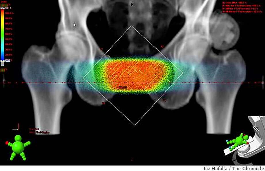 New cancer treatment gives quick, precise doses - SFGate