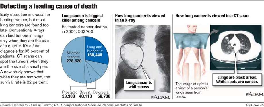CAT scans find lung cancer early death rate falls SFGate