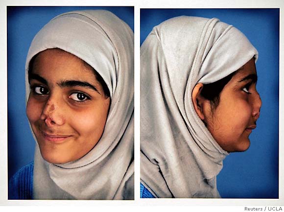 Girl Goes Home To Iraq With Her Nose Restored The US Air Strik