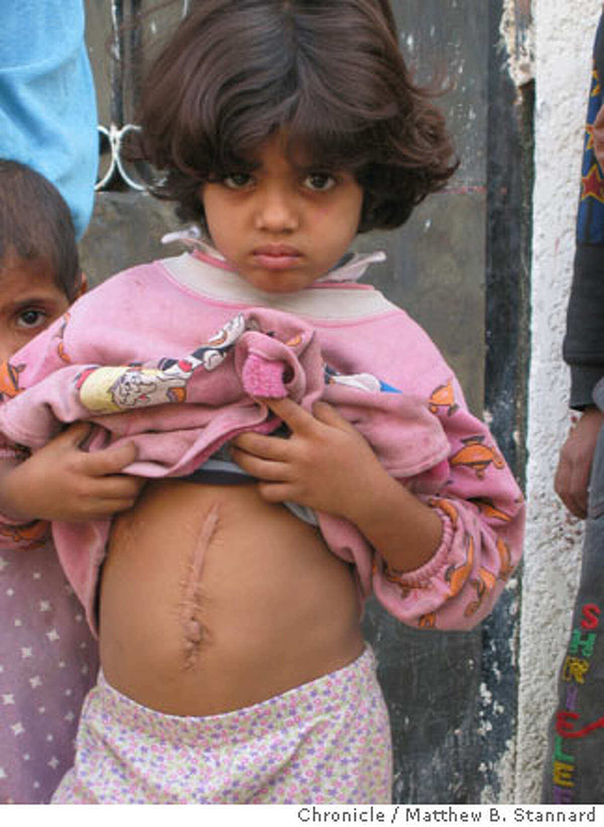 Fatima Edan, 5, shows a thick scar on her belly -- a reminder of an injury from the war. Chronicle photo by Matthew B. Stannard