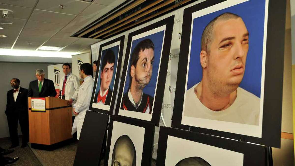 Photos: Before and after face transplant