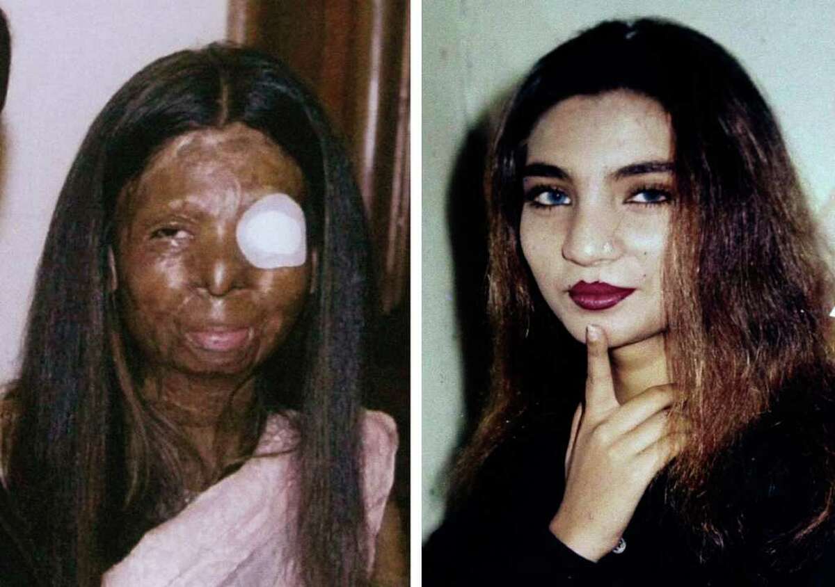 This combination of two undated photos provide by the family shows on the left, Fakhra Younus, some time after an acid attack twelve years ago, allegedly carried out by her then-husband, an ex-lawmaker and son of a political powerhouse; and on the right, Younus sometime before the attack. Younus, who had endured more than three dozen surgeries over more than a decade to repair her severely damaged face and body, finally decided life was no longer worth living. The 33-year-old former dancing girl jumped from the sixth floor of a building in Rome March 17, 2012, where she had been living and receiving treatment. (AP Photo/Courtesy Fakhra Younus Family)