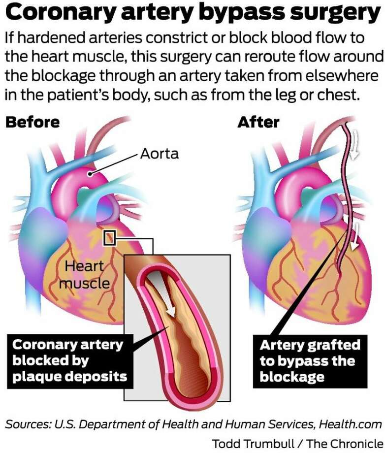 Heart bypass deaths fall as care, reporting improve - SFGate