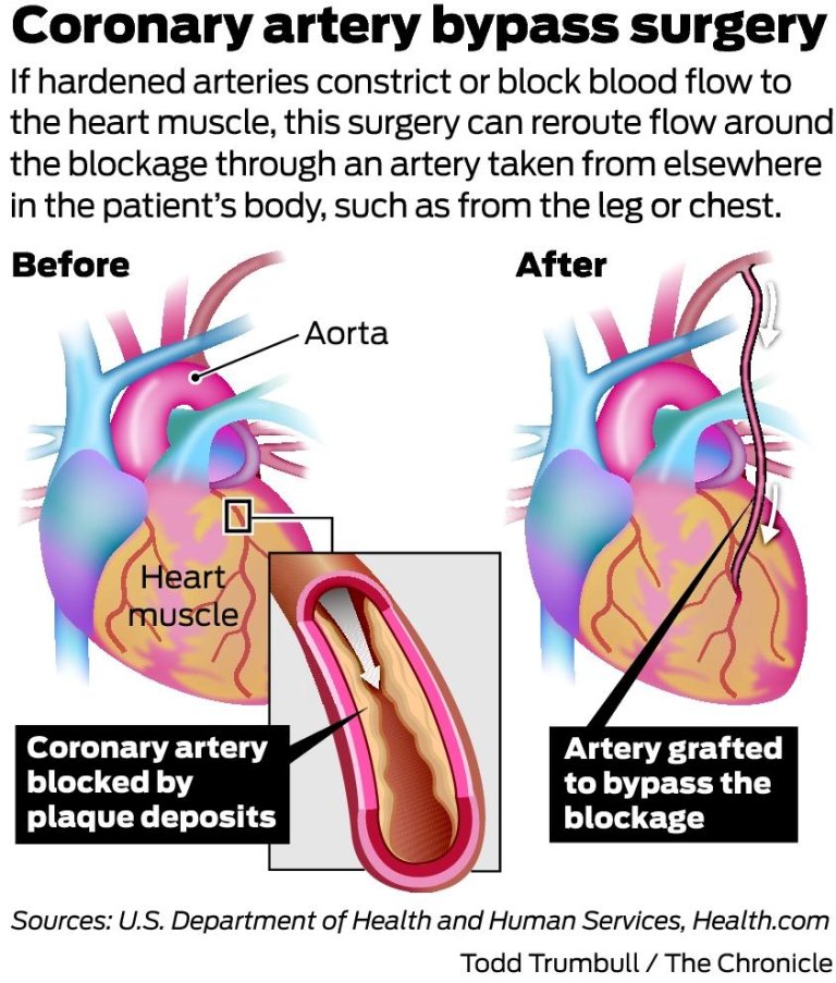 Heart bypass deaths fall as care, reporting improve