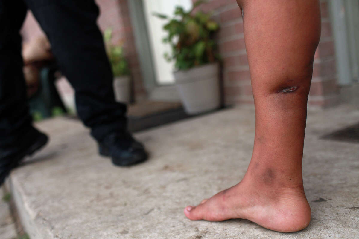 The wounds caused by two dogs attacking her are still visible and healing on the leg of Micahela Garcia as she talks with Animal Care Services Officer Joel Skidmore outside her apartment in San Antonio on Thursday, Feb. 2, 2012.