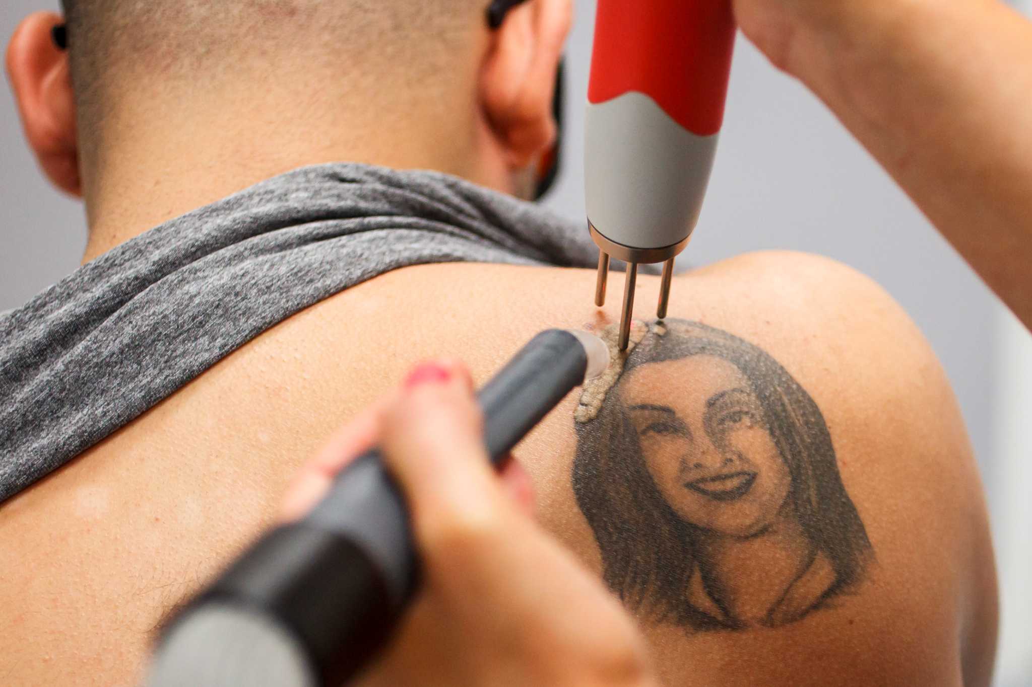 What was I thinking? Locals line up for tattoo removal
