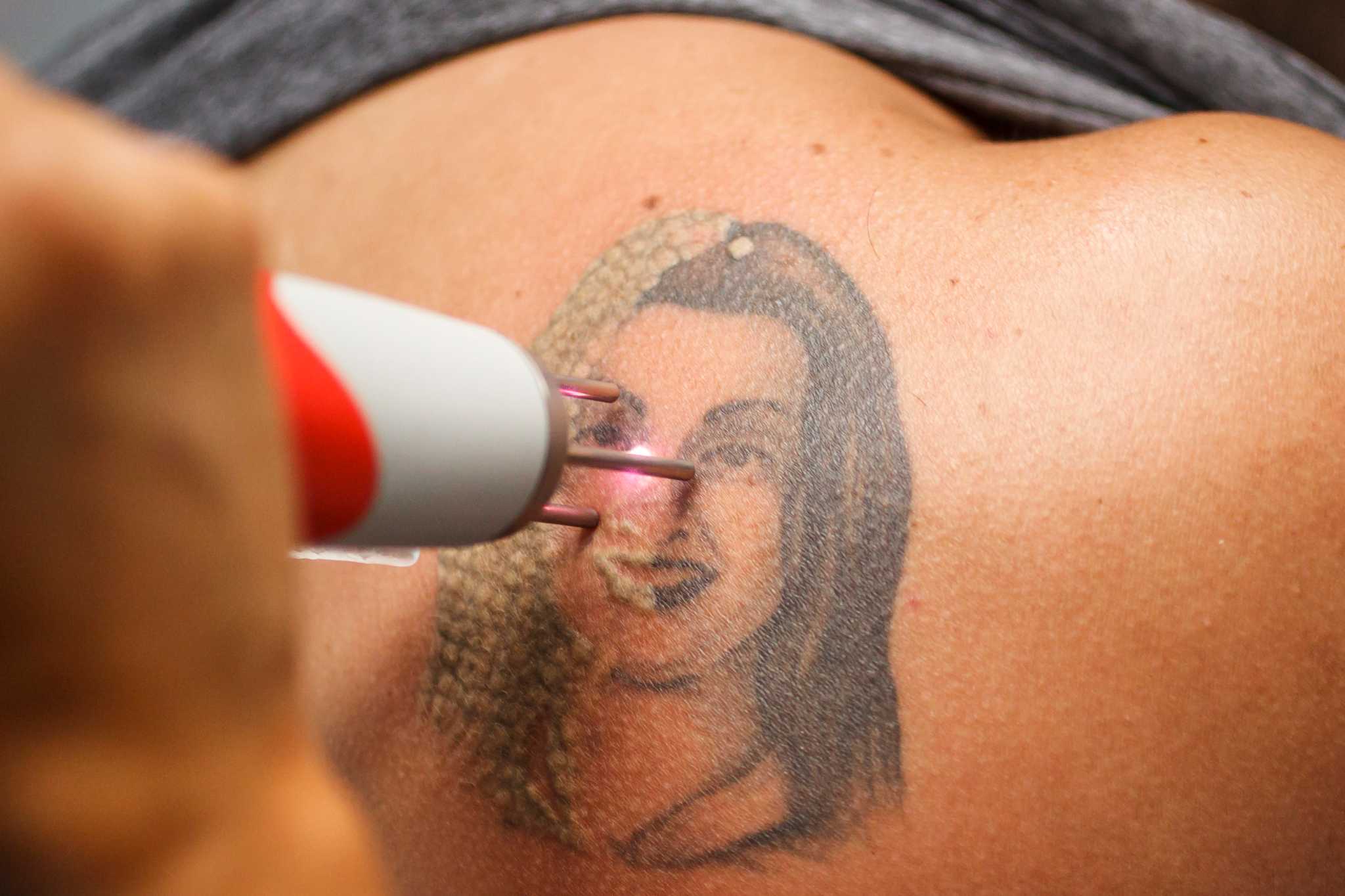 Laser Tattoo Removal in The Woodlands  Houston  Med Spa