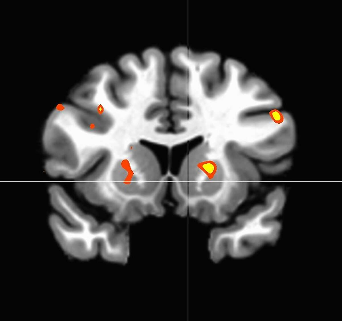 A brain scan of a monk actively extending compassion shows activity in the striatum, an area of the brain associated with reward processing.