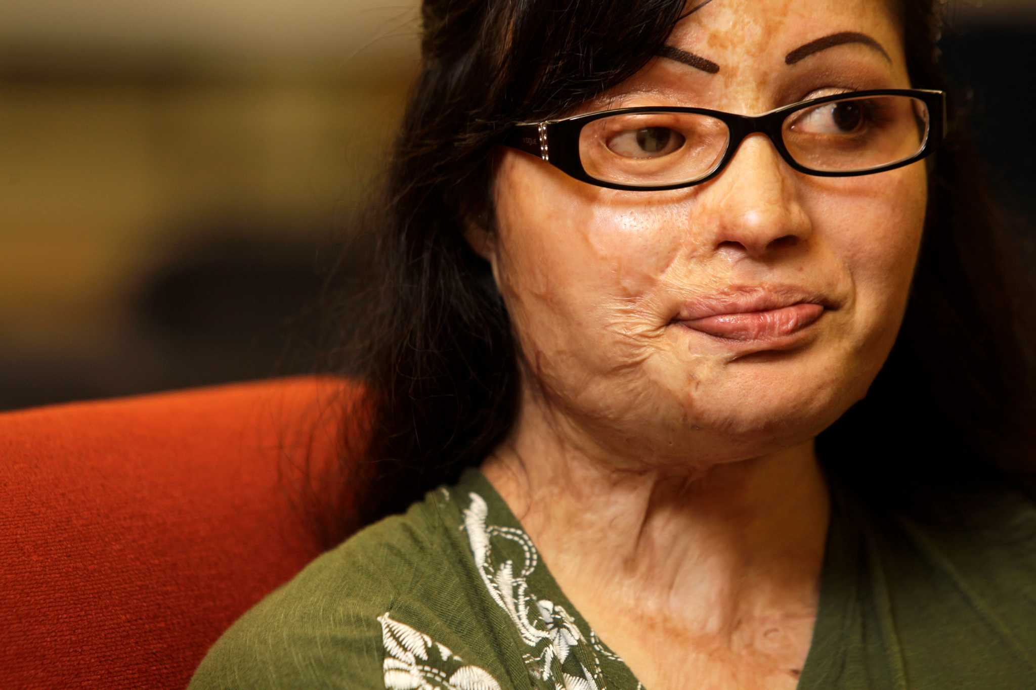 Pakistani acid-attack victim finds new life in Houston - Houston Chronicle2048 x 1365
