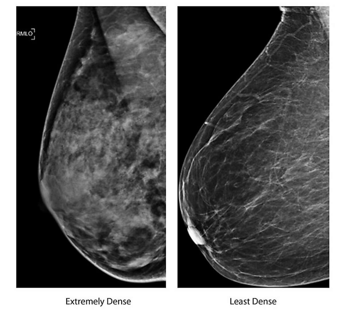 These two undated photos, provided by the American Society of Radiology shows an extremely dense breast, left, and a least dense breast. Women whose breast tissue is very dense have a greater risk of developing breast cancer than women whose breasts contain more fatty tissue. And it can be harder for mammograms to spot a possible tumor because both dense tissue and potentially cancerous spots appear white on the X-ray. This image compares mammograms of an extremely dense breast and an extremely fatty breast. According to the American College of Radiology, most women fall somewhere in between. (AP Photo/American Society of Radiology)