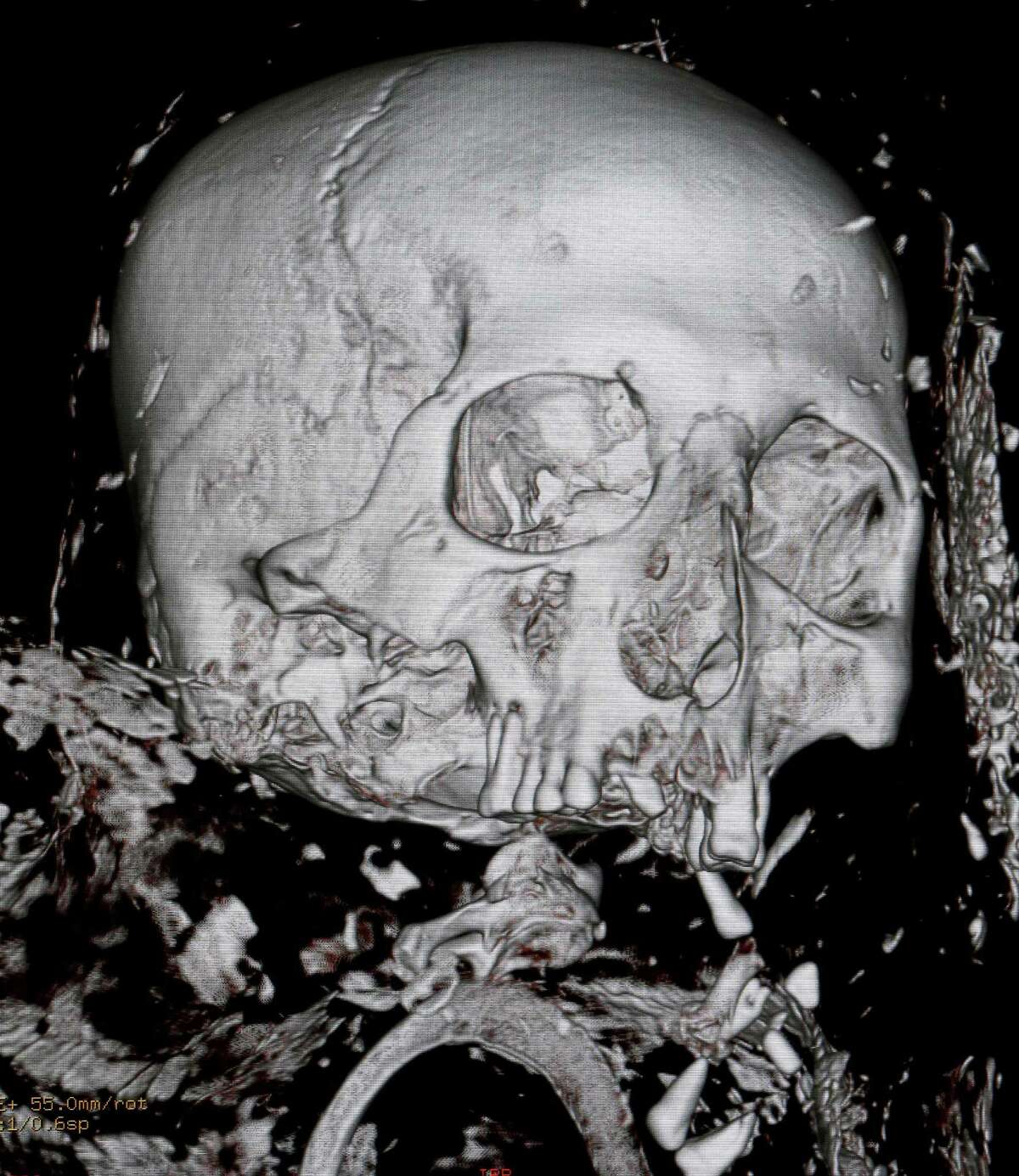 In this Friday, Feb. 1, 2013 photo, a three-dimensional image of a CT scan from a 4,000-year-old Egyptian mummy named Tjeby, from the Virginia Museum of Fine Arts, is shown at the HCA Virginia Imaging center in Richmond, Va. Experts hope the scan will help piece together more information about the mummy itself, as well as a better understanding into the early history of the mummification process. (AP Photo/Steve Helber)