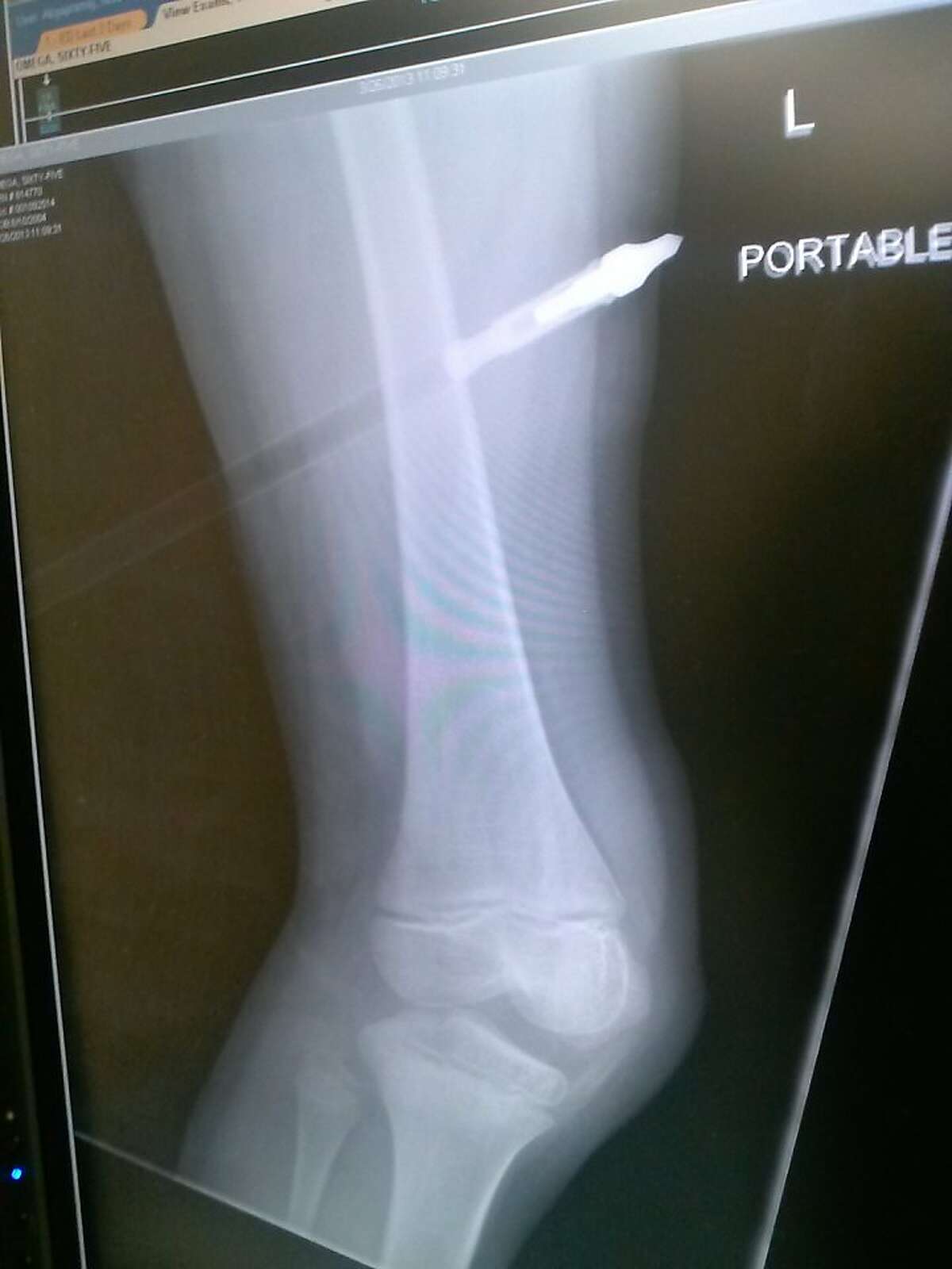 X-ray view of the arrow in Nadine Hairston's leg.