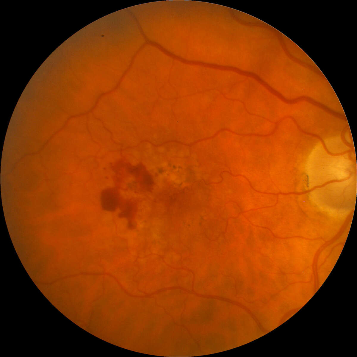 Fish oil doubtful aid in fighting macular degeneration